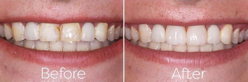 Teeth Restoration Composites Veneers