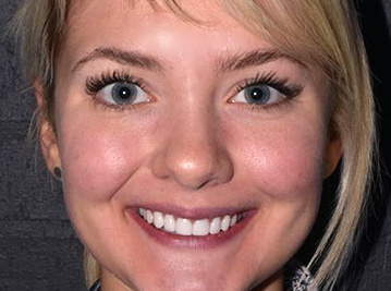 Porcelain Veneers