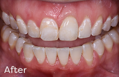 Tooth Whitening Composite Replacement