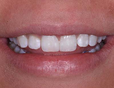 Dental Diastema Closure