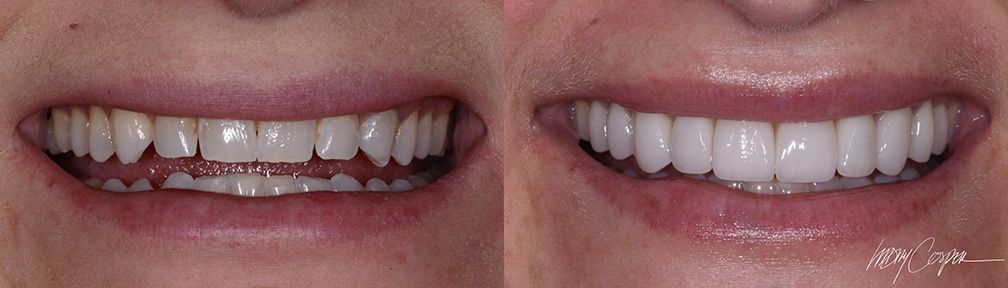 Before and After Cosmetic Veneers by Dr. Lindsey Cosper Before and After Ceramic Veneers