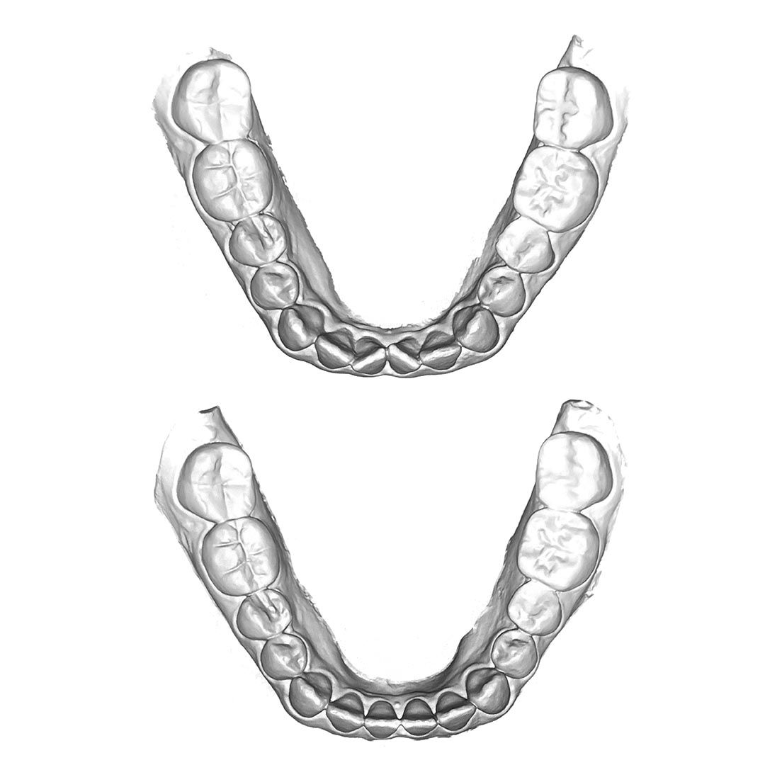 Invisalign Clear Aligners