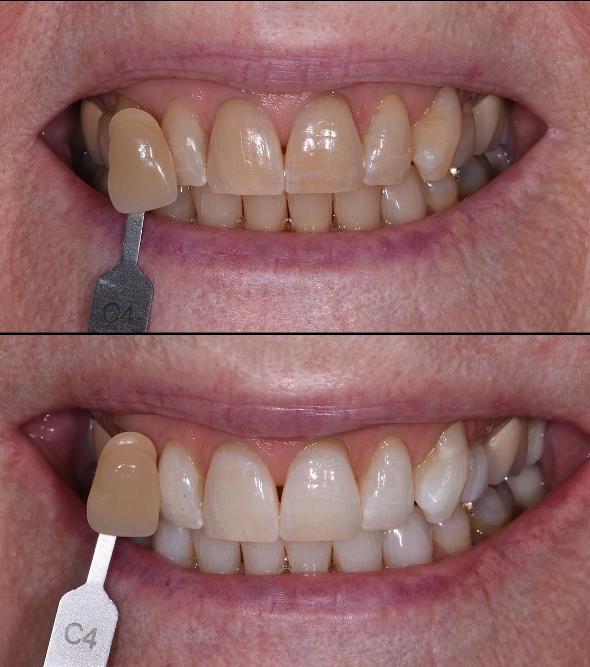 KoR teeth whitening