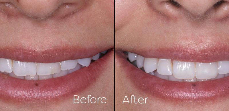 Composite Restorations