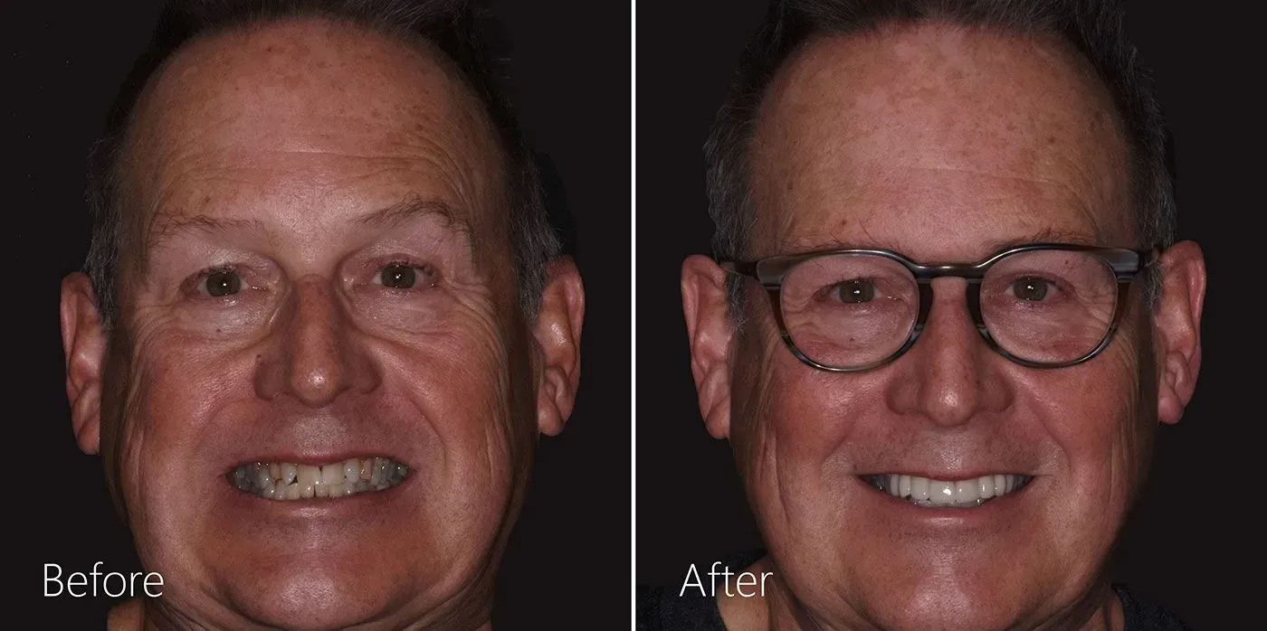 Dental Crowns before and after