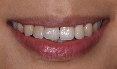 Dental Implant Crown