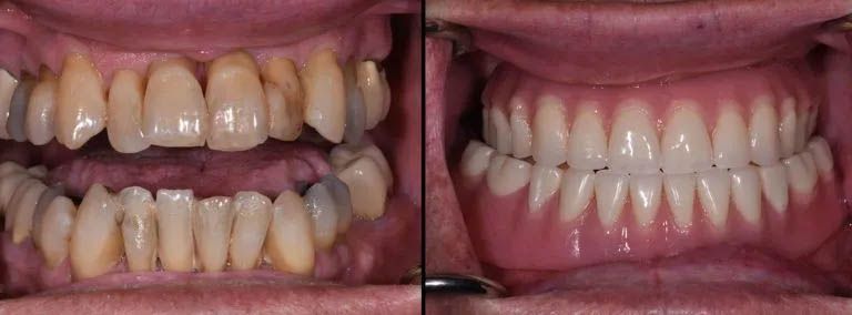 Maxillary Fixed Hybrids and Mandibular Overdenture Tooth Replacement