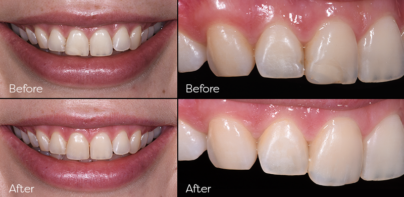 Composite Tooth Replacement
