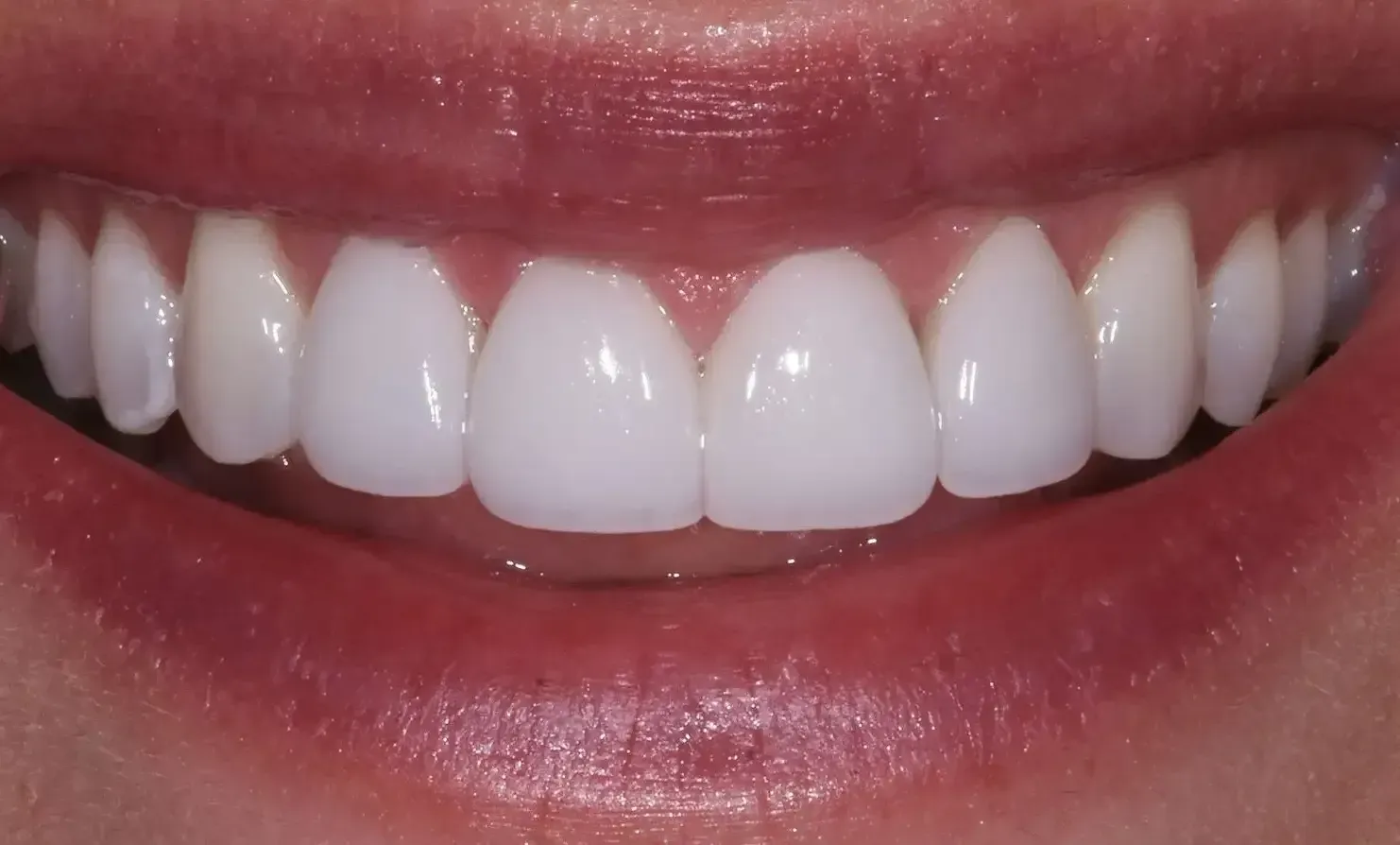 Expert guide on veneers in Fort Collins, CO: longevity, procedure, tooth safety.