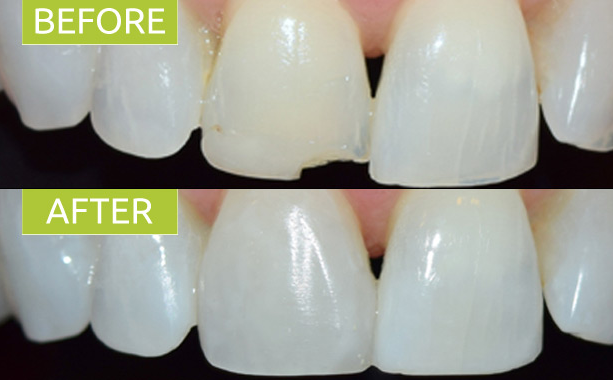 Single Tooth Composite Veneer