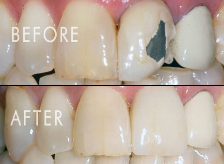 Single Tooth Dental Crown
