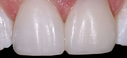 Composite Veneers Teeth Whitening