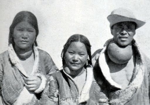 这家藏族人脖子上巨大的甲状腺肿在宣教医院得到了成功治疗