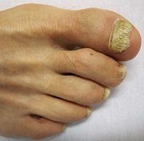fungal nail infection