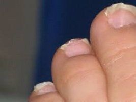 broken toe nails