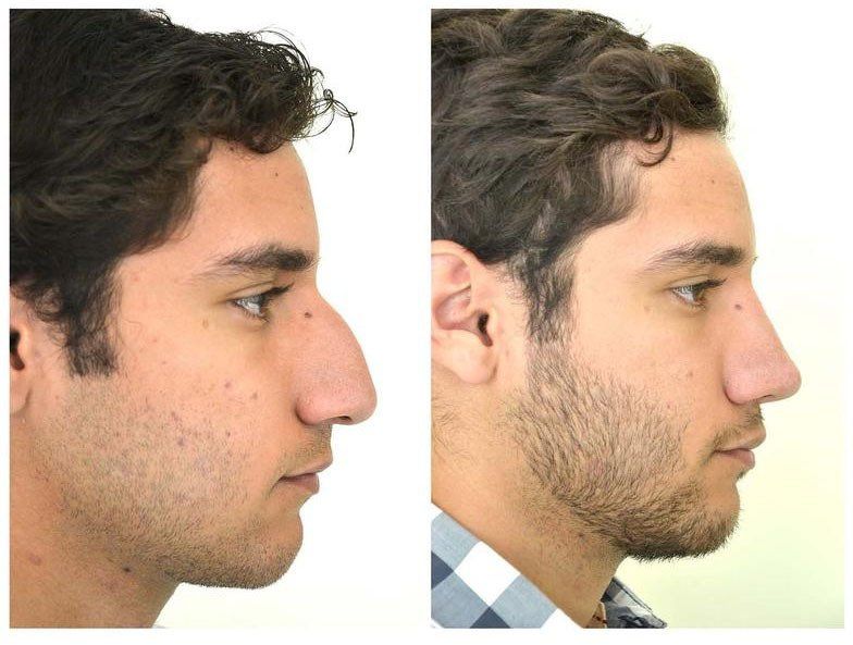 cirugia de nariz en guadalajara