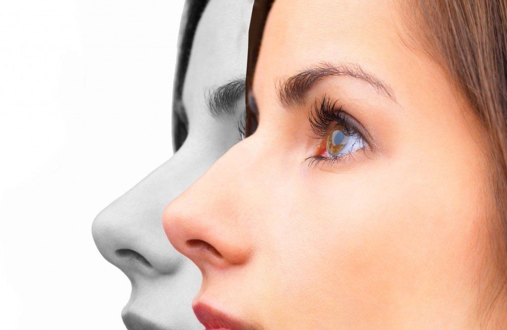 Cirugia de Nariz Guadalajara