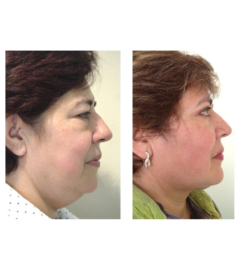 blefaroplastia antes y despues