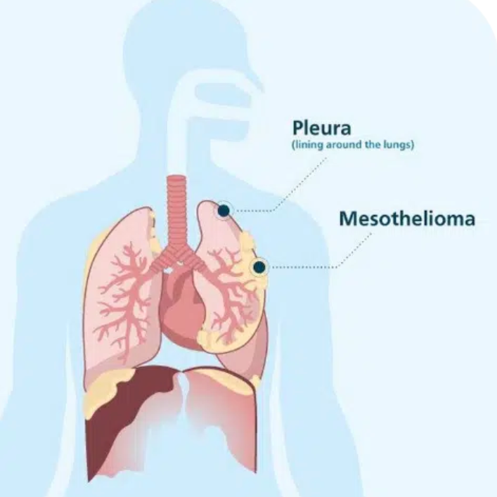Free Mesothelioma Guide