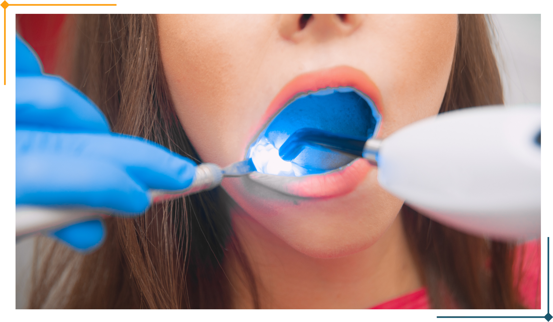 Mouth Restoration at Orion Family Dental Los Alamitos CA