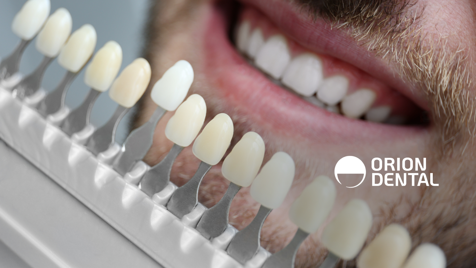 A close up of a man 's teeth next to a tooth color chart.