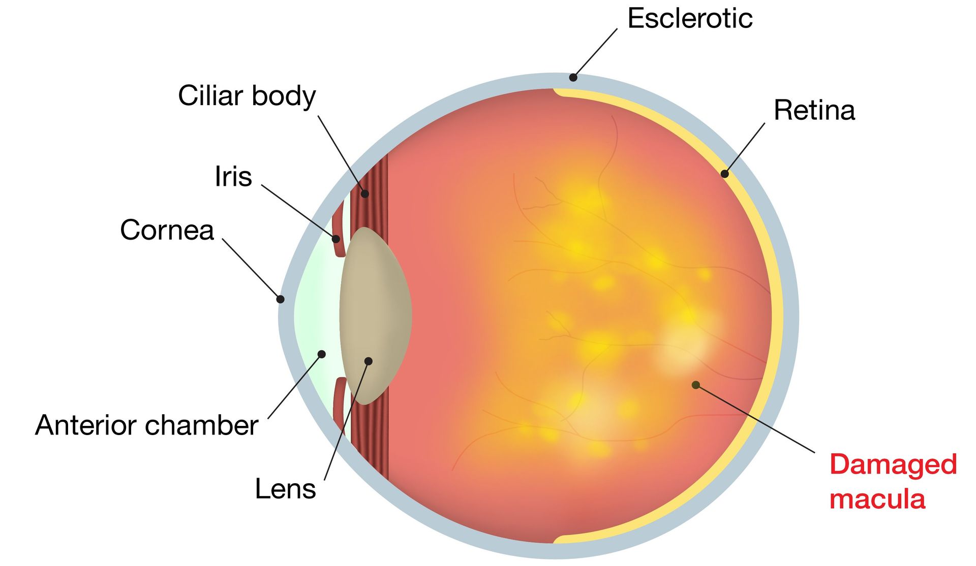 Macular Degeneration