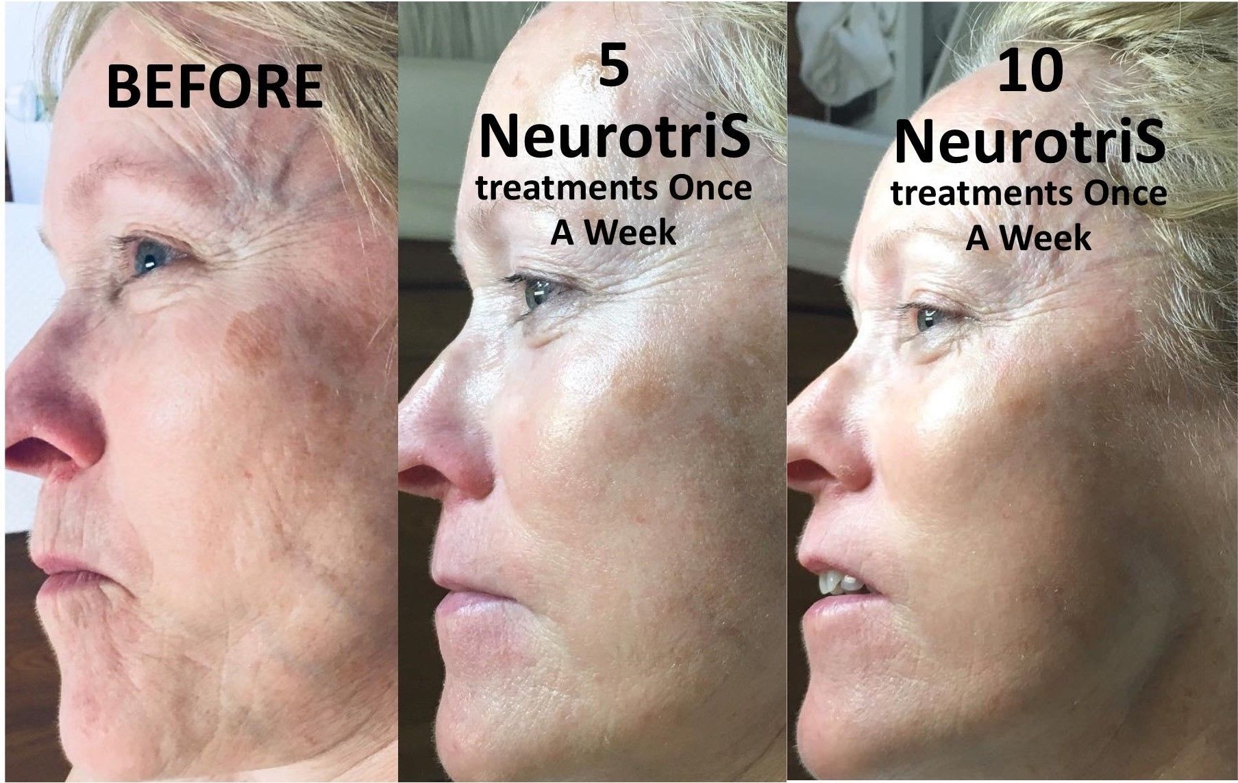 A woman's face is shown before, at 5 and at 10 NeurotriS treatments once a week for facial lifting and skin renewal.