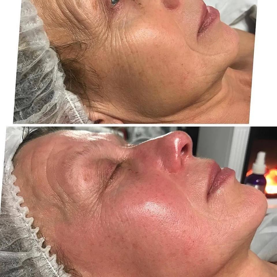 A woman 's face is shown before and after a NeurotriS treatment.