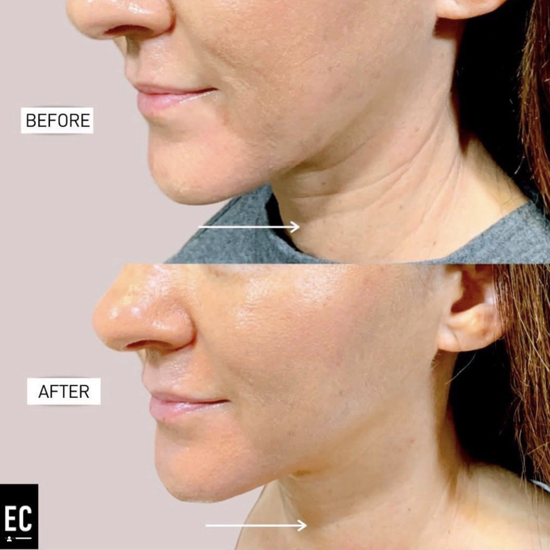 Before After Advanced Microcurrent Science for Anti Aging