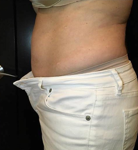 Abdomen profile before NeurotriS Body treatments for inch loss and toning.