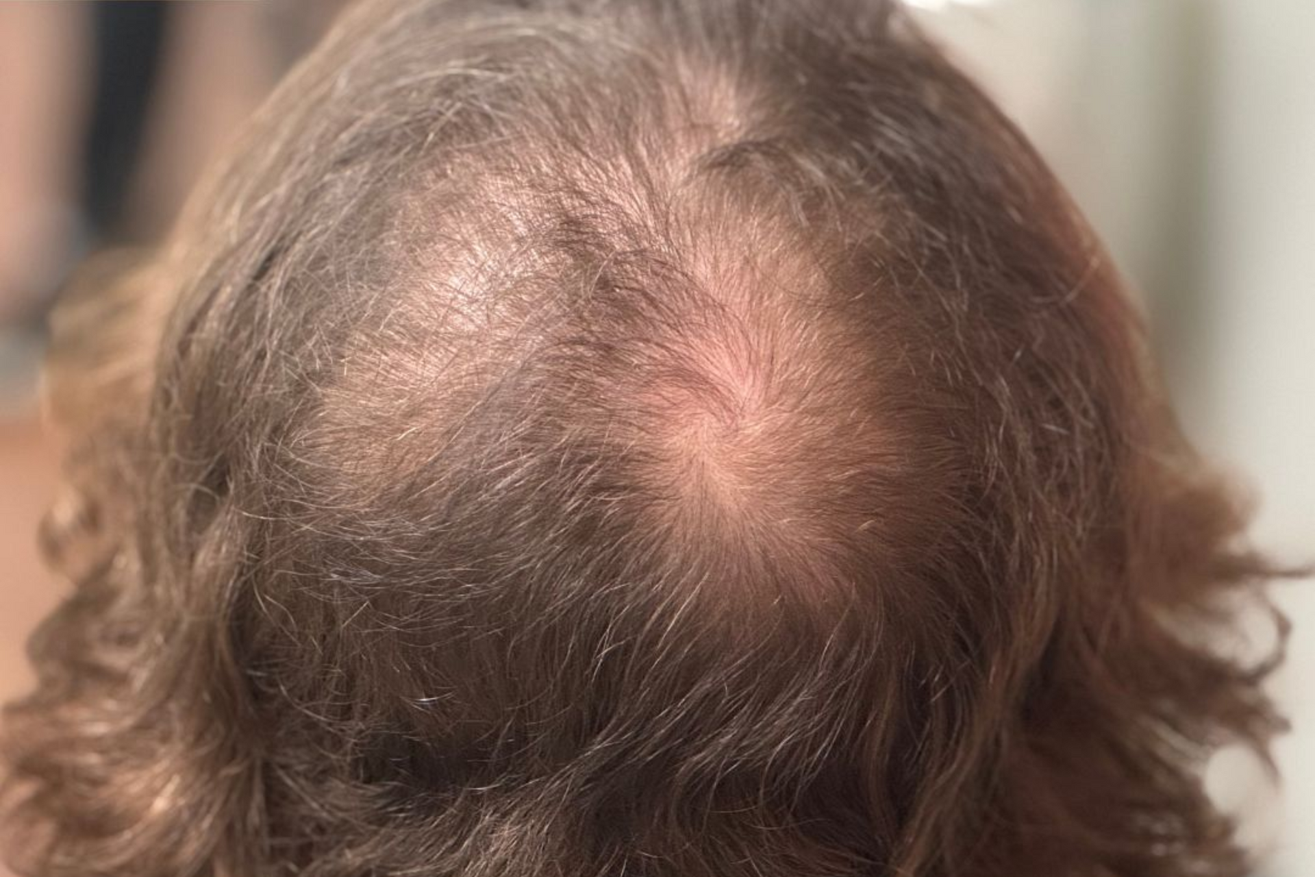 Person's head showing thinning hair on the crown. Brown hair, light skin.