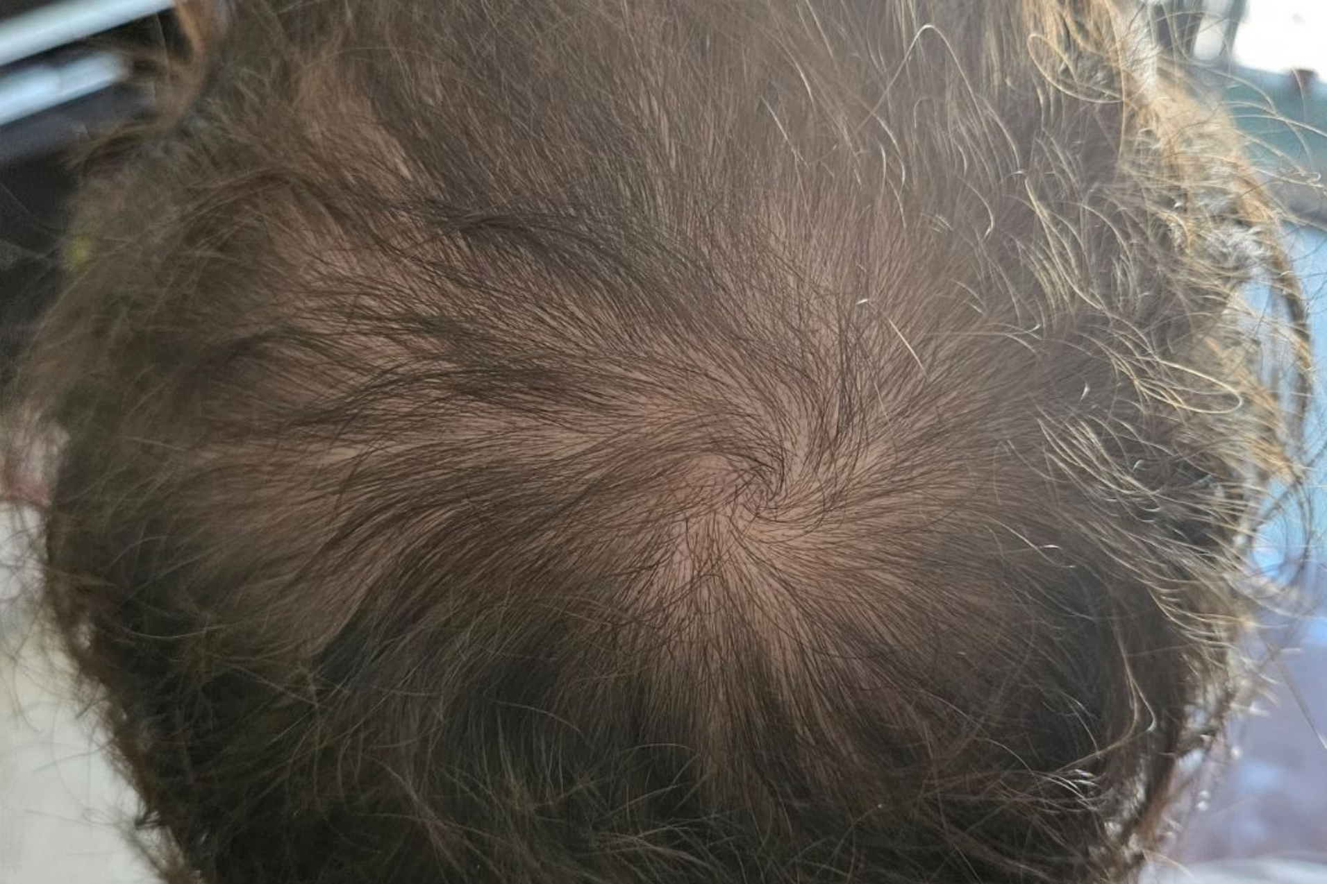 Close-up view of a person's dark brown hair, showing the crown and hair growth pattern in a swirl.