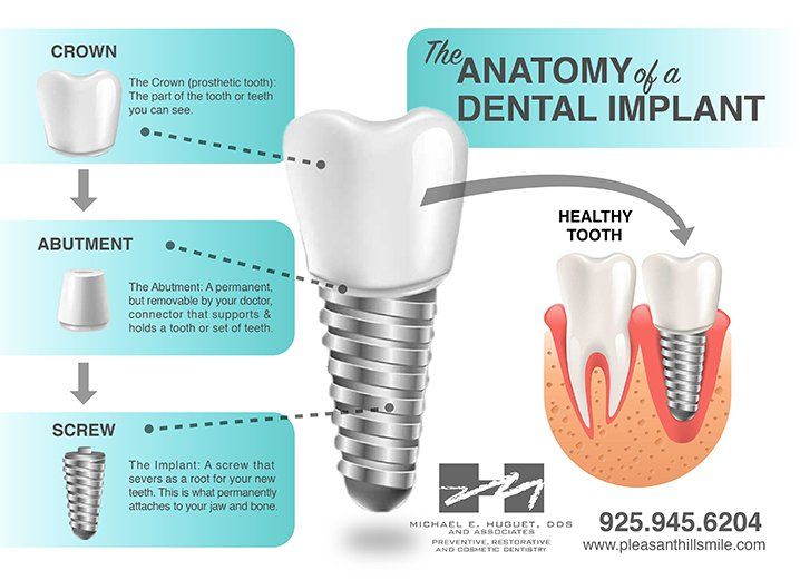REBUILD YOUR SMILE WITH DENTAL IMPLANTS