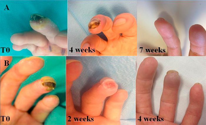 Progressione delle lesioni alla punta delle dita. La guarigione avviene nell'arco di diverse settimane, con cambiamenti di colore e aspetto.