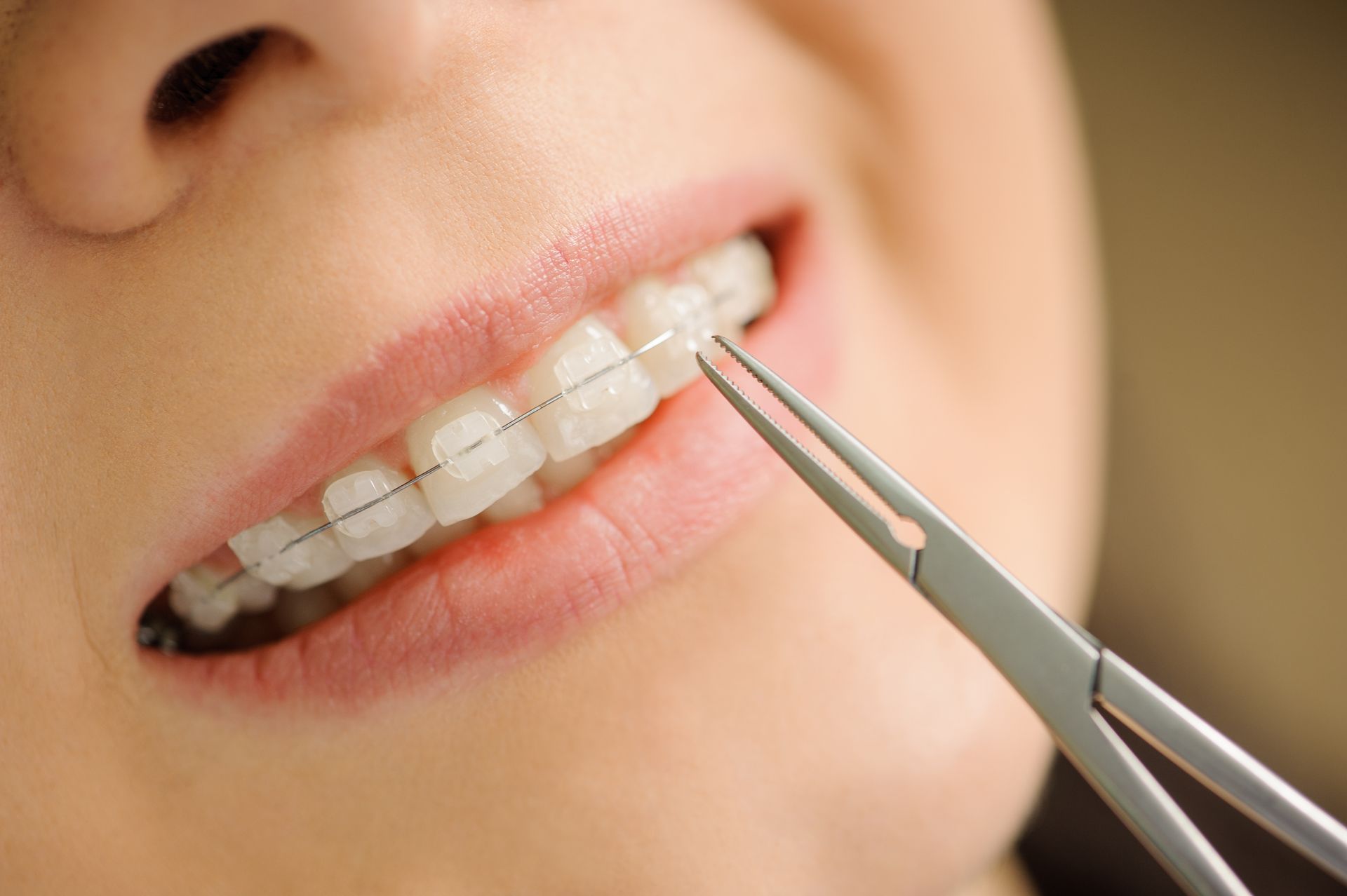 Close-up of ceramic braces on teeth as a dental tool adjusts the wire. Close-up of ceramic braces on teeth as a dental tool adjusts the wire.