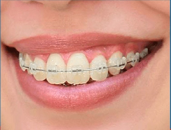 smiling mouth with cler braces
