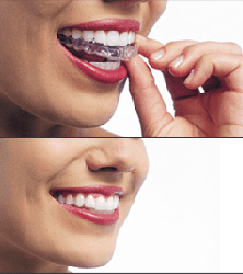 Invisalign braces on female putting them and showing us how they are invisible