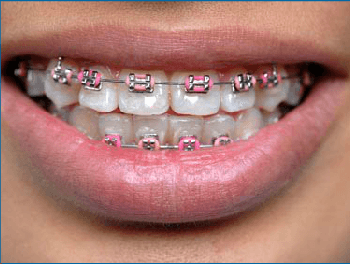 smiling female mouth with pink braces showing