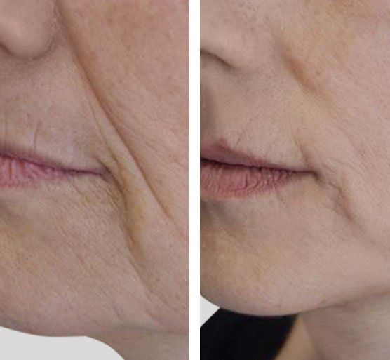 Endosphères Therapy