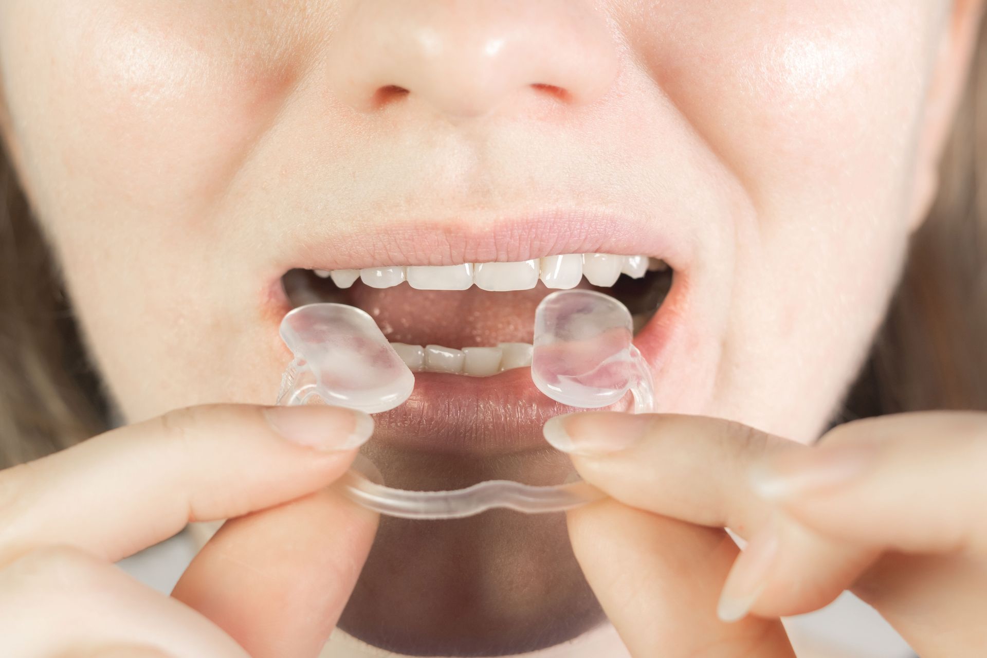 Person inserting clear aligner trays into mouth.