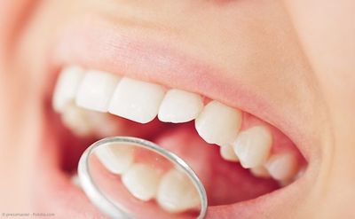 Zahn- und Kieferfehlstellungen können zu gesundheitlichen Problemen führen