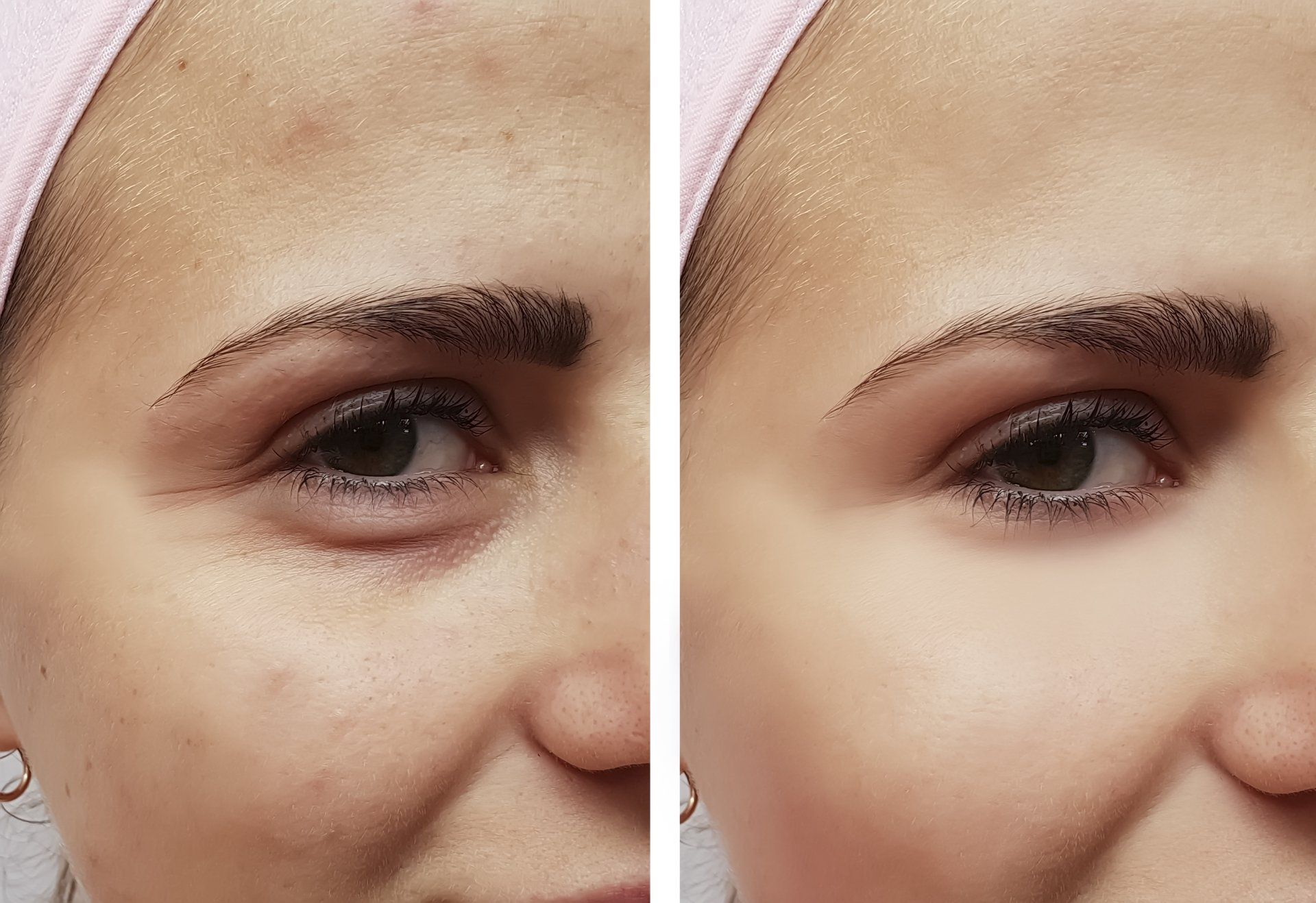 Before and After Wrinkle Reduction Treatment — Brick, NJ — Dr.Park Ave