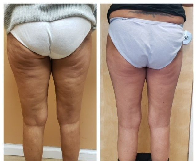 Tighten Skin and Reduce Cellulite, Wrinkles, and Circumferential