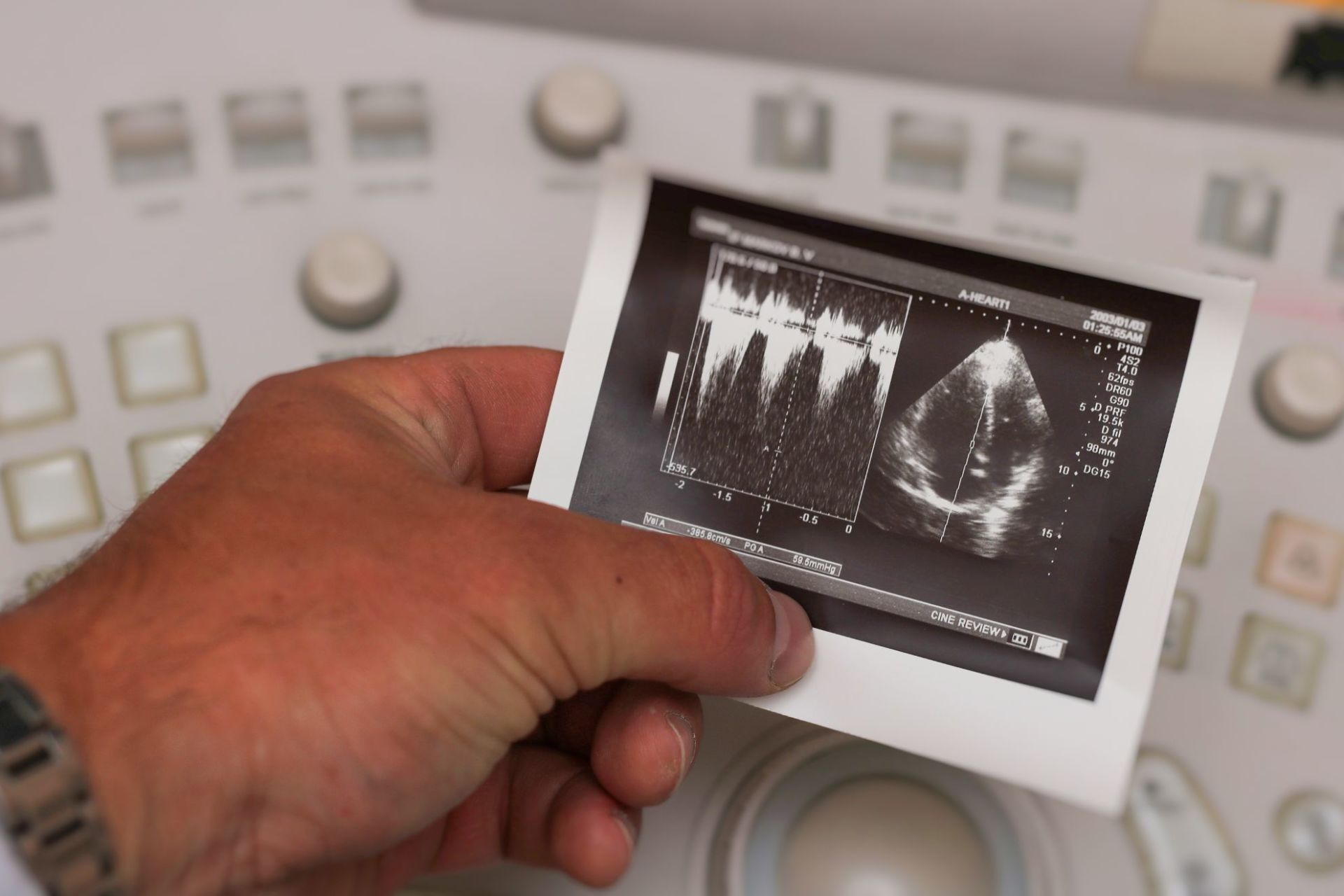 Risultati ecocolorDoppler