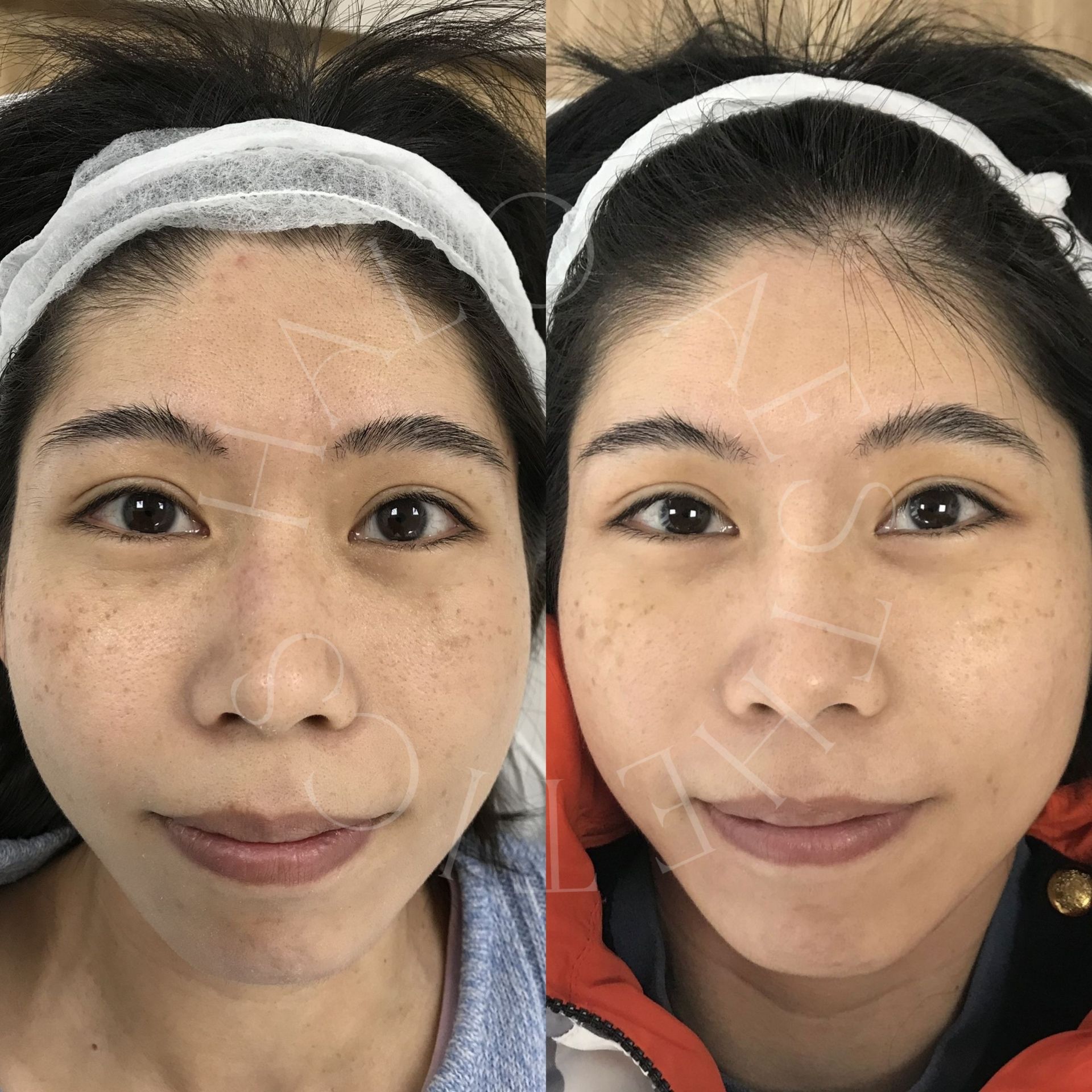 skin lightening milton keynes