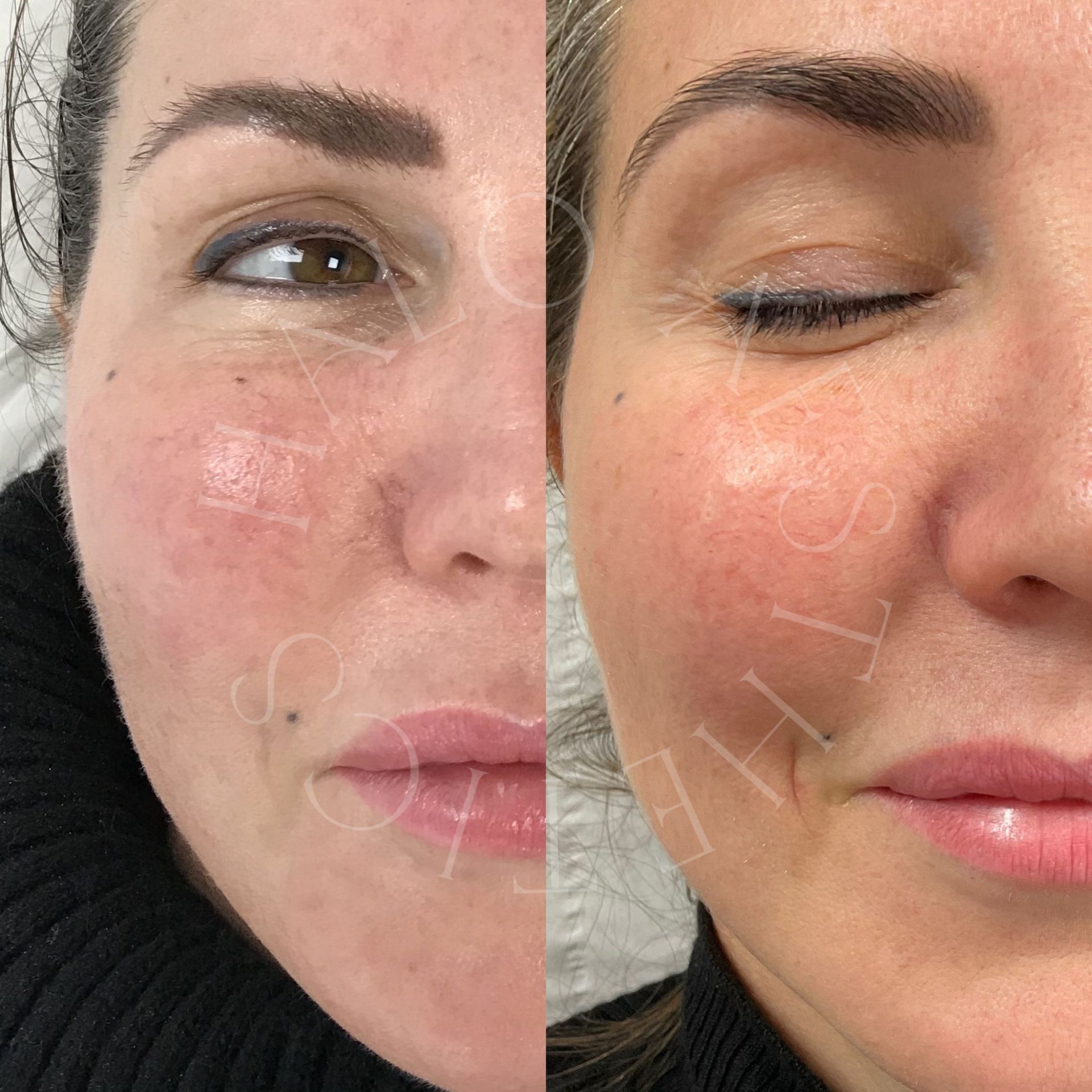 rosacea treatment milton keynes