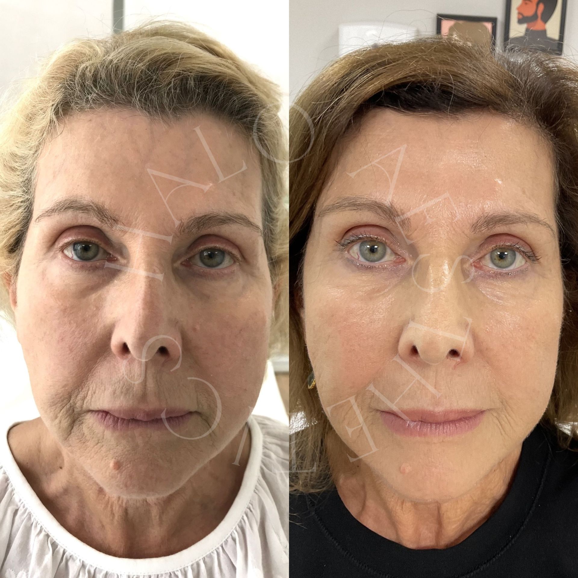 profhilo milton keynes