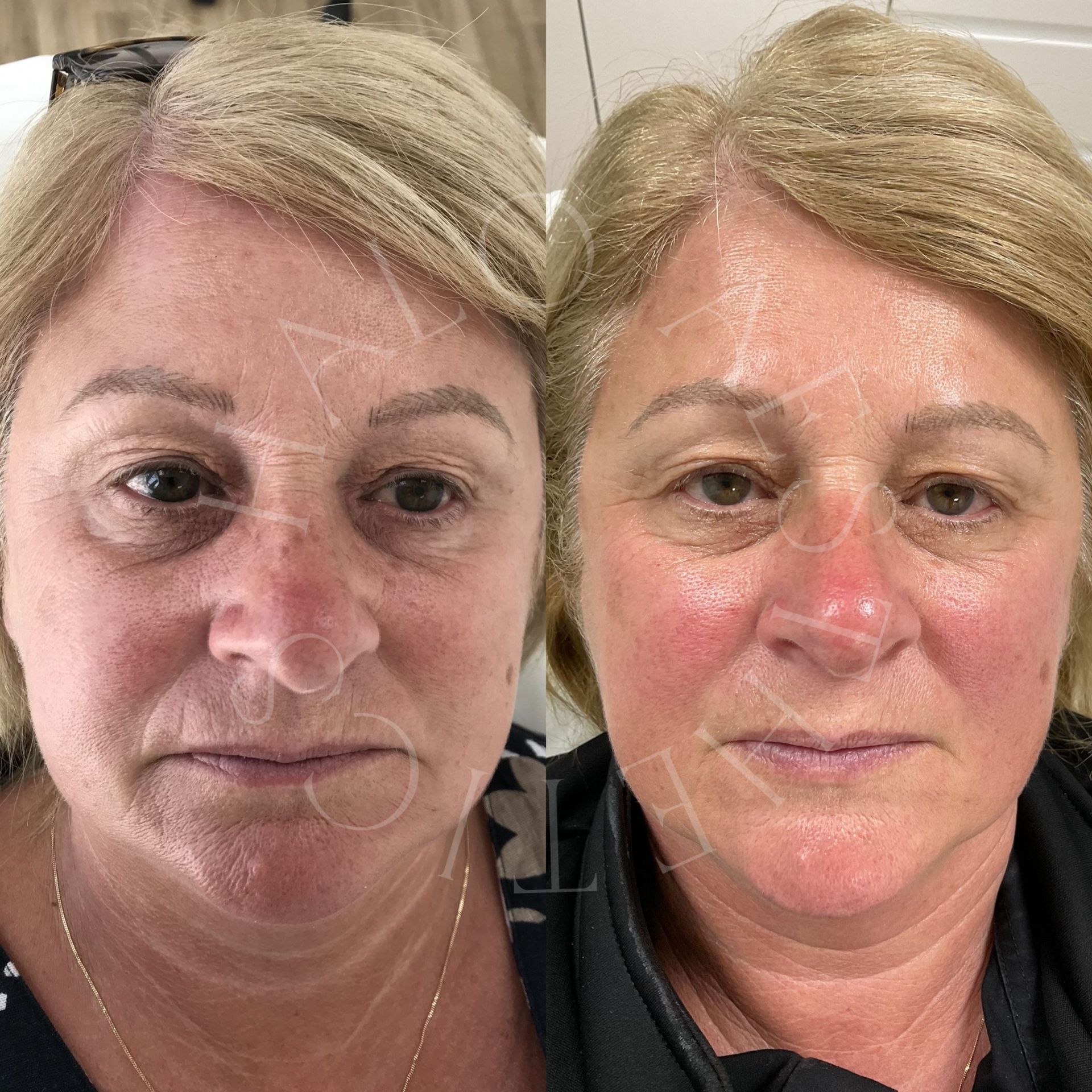 rf microneedling milton keynes