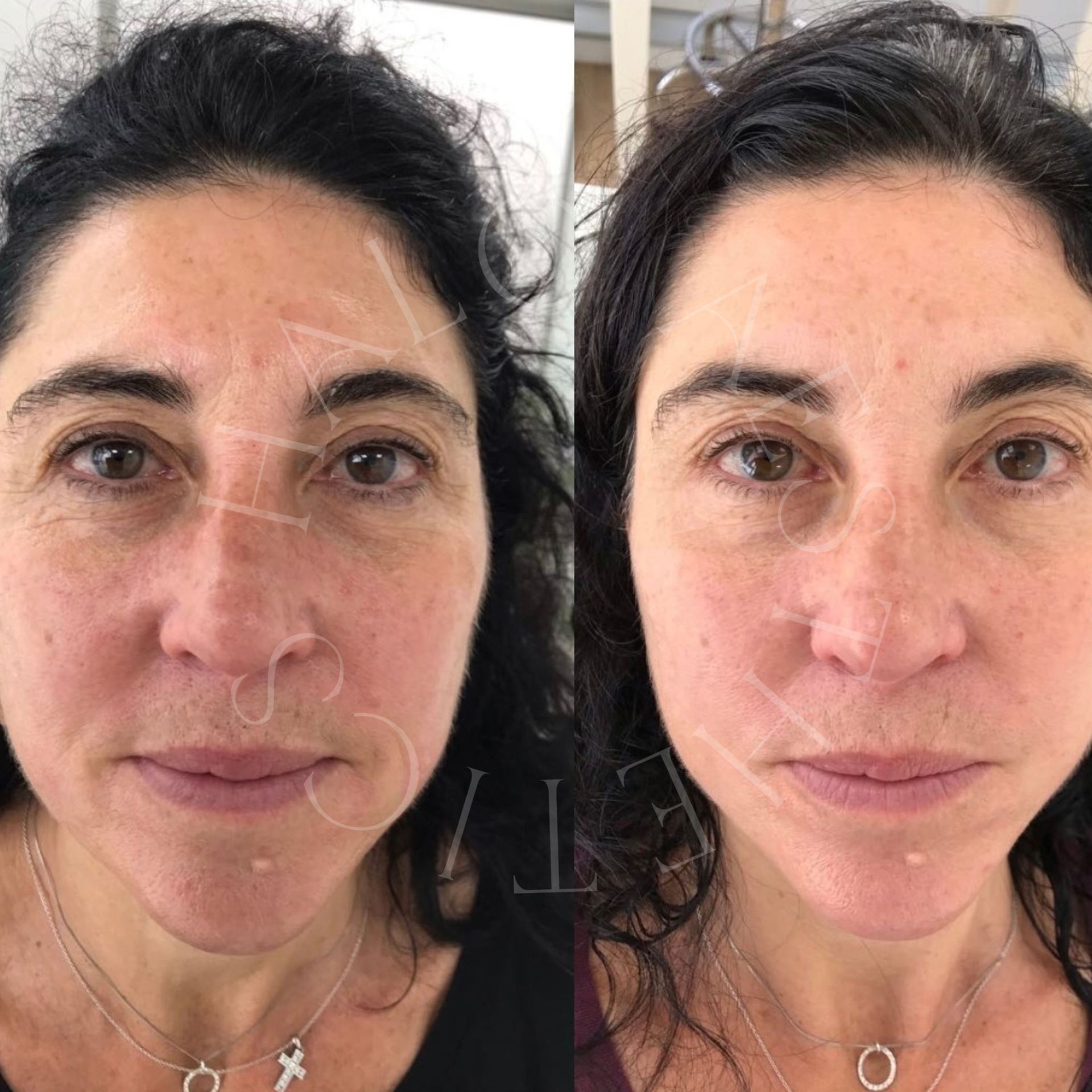 radiofrequency microneedling milton keynes