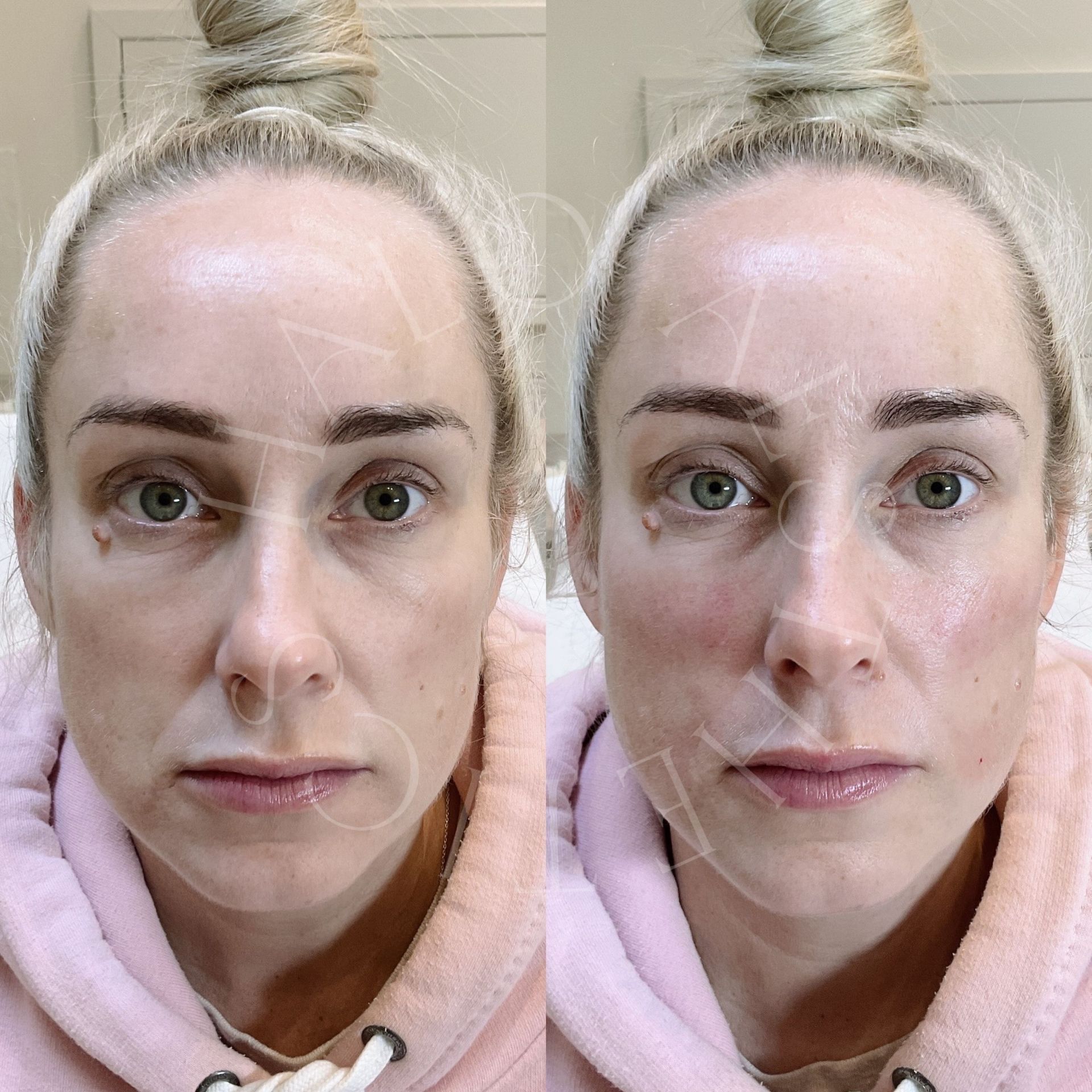 dermal filler milton keynes